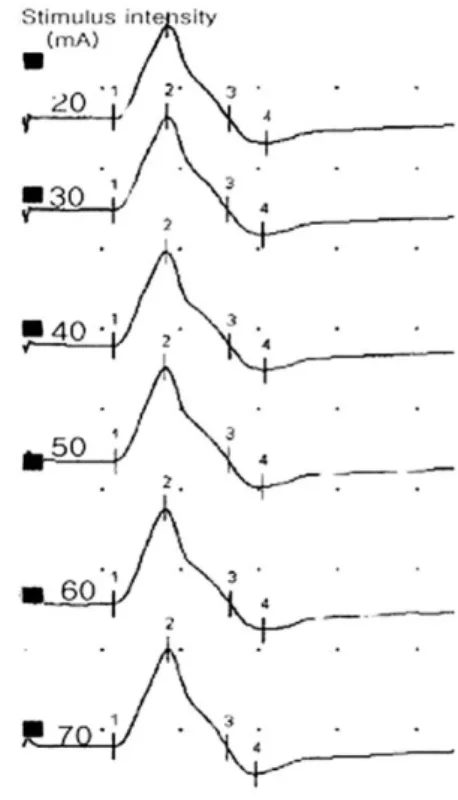 Fig. 3. No changes in onset latency though the stimulus intensi- intensi-ty is more increased than supramaximal stimulation