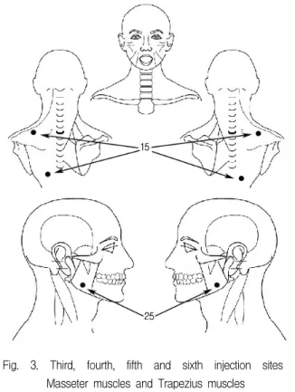 Fig.  3.  Third,  fourth,  fifth  and  sixth  injection  sites  :  Masseter  muscles  and  Trapezius  muscles