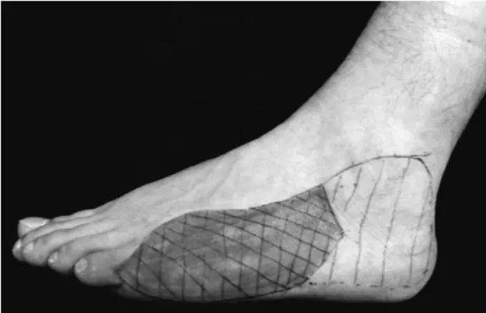Table 1. Sensory Conduction Study of Sural and Lateral Dorsal Cutaneous Branch of Sural Nerve (LDCBSN).