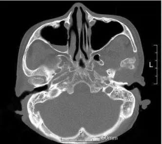 Fig. 2. Postoperative clinical photograph for case 1 shows a 30-mm  range of mouth opening.