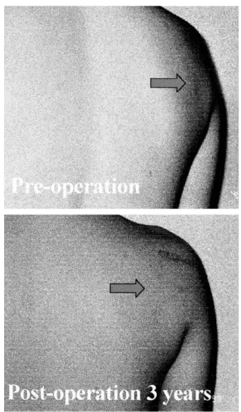 Fig. 2. Pre- and post-operation state photographs showing the back of the patient.