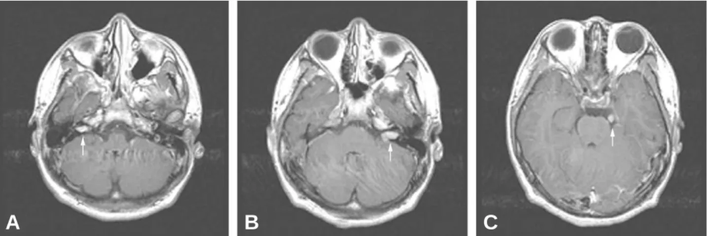 Fig. 1. Brain MRI shows multiple neurofibroma involved in left fifth and both eighth cranial nerve (white arrows)