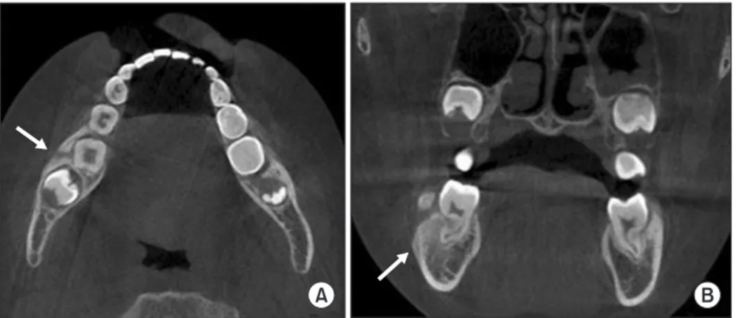 Fig. 1. Panoramic radiographic image of the patient at the first visit  showed mixed dentition without any notable lesion.