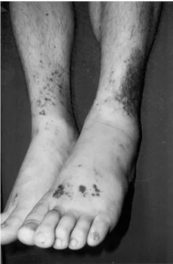 Fig. 2. Severe visible muscle atrophy in the left hand first-web space.