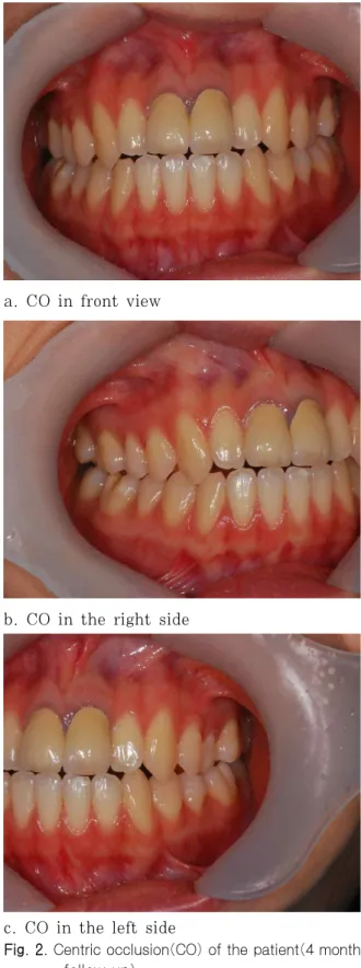 Fig. 1. Centric occlusion(CO) of the patient (2 weeks after the injection of botulinum toxin on masseter muscle on both side)