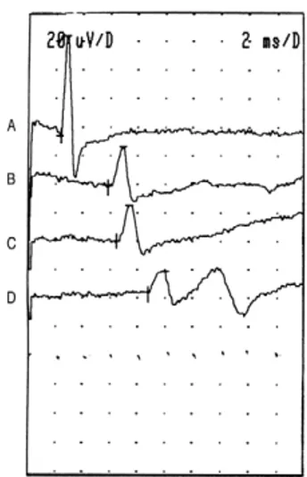 Fig. 4. Segmental motor conduction study. Stimulation site: A, wrist (15.6 mV); B, elbow (15.5 mV); C, above elbow (15.3 mV); D, axilla (15.2 mV).