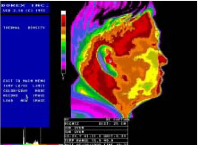 Fig.  5.  Lateral  thermogram  of  a  subject,  attaching  ring-shaped  markers  on  the  skin  of  palpation  points