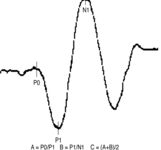 Fig. 1. Waveform of lower extremity SEP study