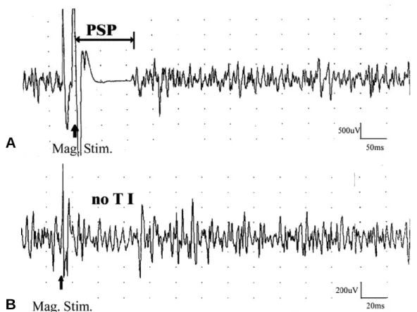 Table 1. The Values of Motor Threshold, Postexcitatory Silent Peorid and Transcallosal Inhibition in Two Groups.
