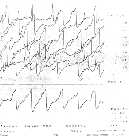 Fig. 2. Needle EMG revealed synchronized action potentials of 50~60 Hz in the quadriceps muscles bilaterally during muscle spasm.