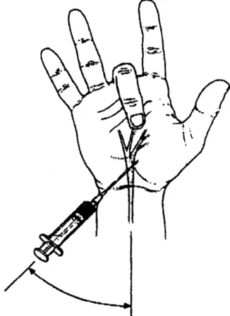 Fig. 1. Diagram illustrating point of entry and direction of injecting needle. The needle directed at the point where the tip of fully flexed middle finger was placed.