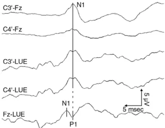 Fig. 1. Representative pattern of somatosensory evoked poten- poten-tials elicited by stimulation of right median nerve and recorded with different recording methods