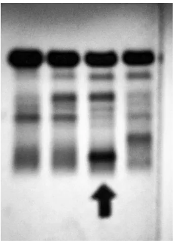 Fig. 1. : Immunoglobulin G- λ type gammopathy