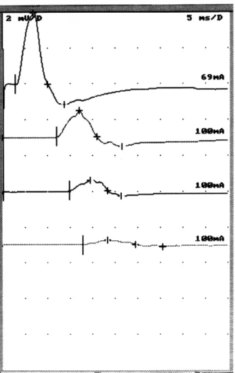 Fig. 2. : Multiple hot uptake on manubrium, T7, T12, L1, cra- cra-nium, both tibias, both knees and ankle joints