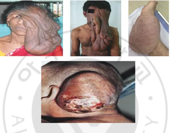 Figure  2. Various phenotypes of plexiform neurofibromas and MPNSTs found  in patients with NF1