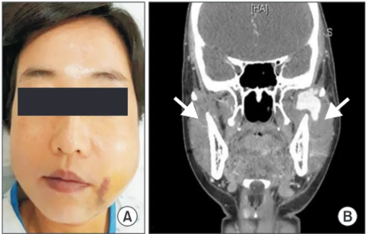 Fig. 3. Two weeks after embolization procedure. The left facial  swelling and relating symptoms were disappeared.