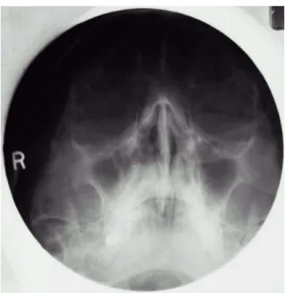 Fig.  3.  The  coronal  magnetic  resonance  imaging  of  the  head.