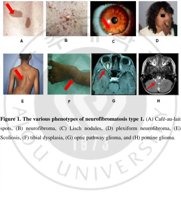 Figure 1. The various phenotypes of neurofibromatosis type 1. (A) Café-au-lait  spots,  (B)  neurofibroma,  (C)  Lisch  nodules,  (D)  plexiform  neurofibroma,  (E)  Scoliosis, (F) tibial dysplasia, (G) optic pathway glioma, and (H) pontine glioma