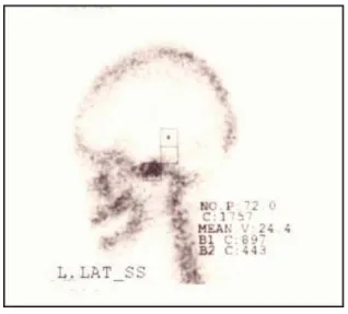 Fig.  1. Lateral  view  of  planar  scintigraphy  showing  increased  radionuclide  uptake