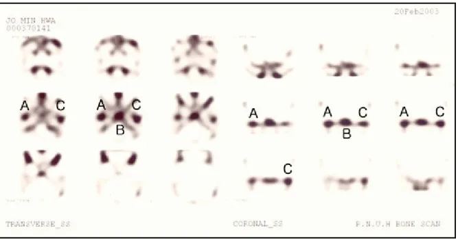 Fig.  2. Transverse  and  coronal  axis  images  of  SPECT.  A(right  side)  and  C(left  side)  mean  hot  spots