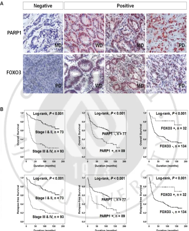 Figure  3.  Immunohistochemistry  expression  of  PARP1  and  FOXO3  and  Kaplan- Kaplan-Meier survival analysis in gastric carcinoma