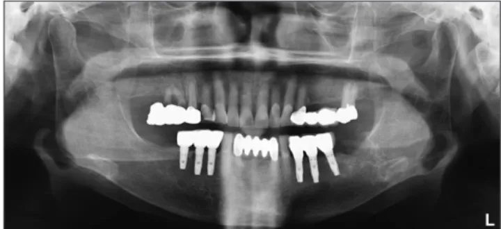 Fig. 1. Left mandible third molar extraction socket on panoramic  view at first visit.