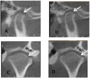 Fig. 1. Sagittal(A,B) and coronal(C,D) reconstruction of CBCT images showed erosive bone change was arrested and the cortical bone became well defined
