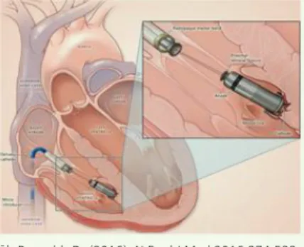 그림 1. 우심실의 Micra™ TPS (Micra Transcatheter Pacing System) 삽입술