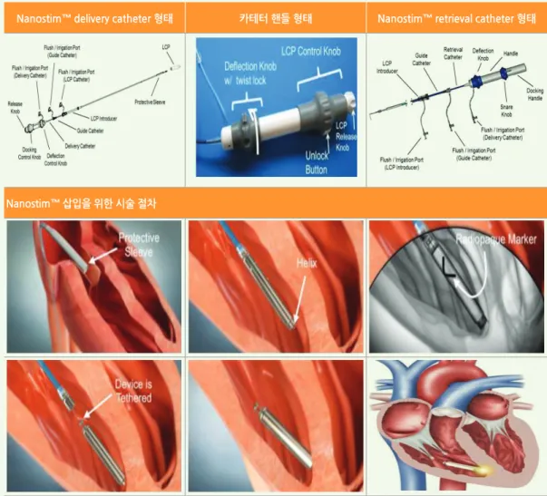 그림 2. Nanostim™ 시술 시 사용되는 카테터와 시술의 절차