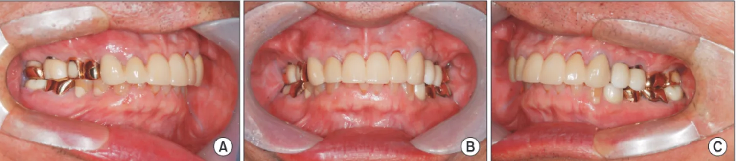 Fig.  6.  Case  2.  Panorama  (A)  and  temporomandibular  joint  panorama (B) image taken at the first visit.