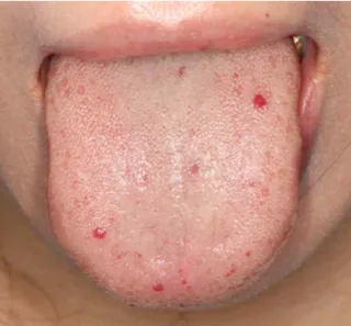 Fig. 4. Telangiectasia on finger.