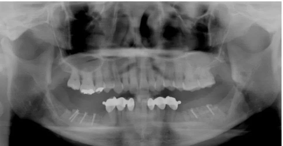 Fig. 4. Case I: Panoramic view of autogenous block bone graft surgery.