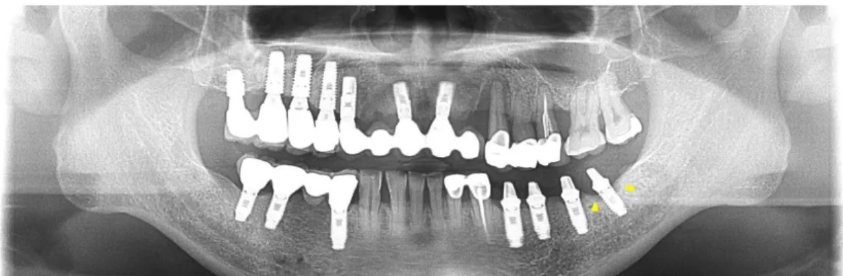Fig. 1. Panoramic radiograph of Case 1 at baseline. Yellow arrows show marginal bone levels.