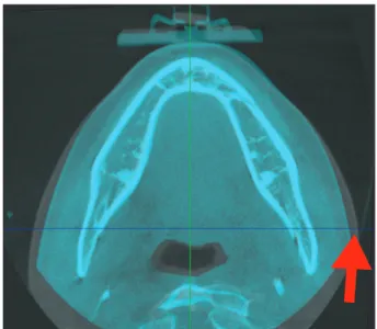 Fig. 1. Superimposed cone-beam computed tomography image and  measurement of soft tissue changes (arrow).