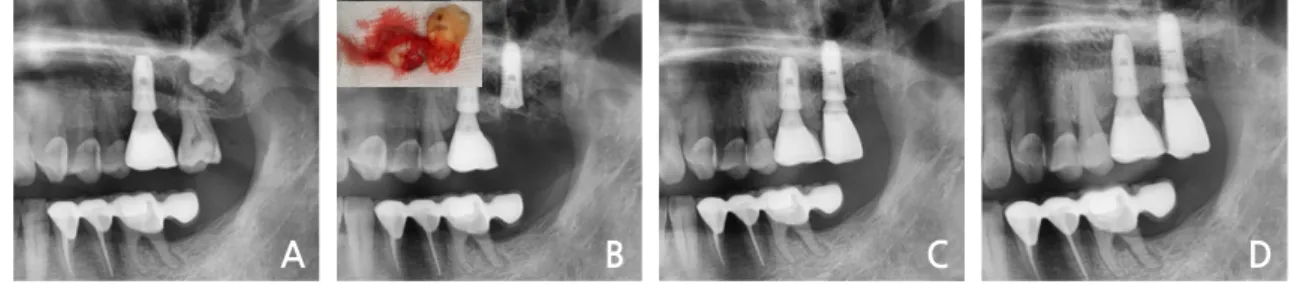 Fig. 1. (A) Cystic lesion on the coronal area of the left maxillary third molar, (B) Immediate implant  placement with sinus lift after extraction of the left maxillary 2nd &amp; 3rd molars, (C) Loading after 2 