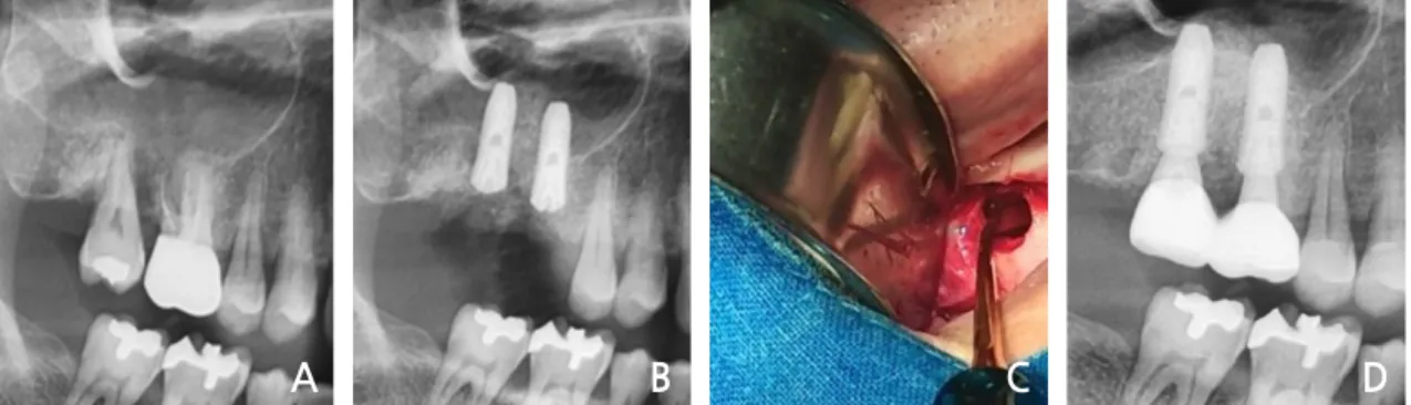 Fig. 2. (A) Bone loss at the right maxillary 1st and 2nd molars area, (B) Immediate implant placement  with sinus lift, (C) Window opening, (D) Panoramic view at the 3-years follow-up.