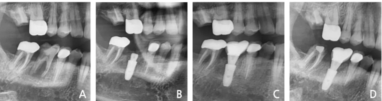 Fig. 4. (A) Periapical lesion of the mandibular 2nd premolar area, (B) Immediate implant placement  with bone graft, (C) Loading after one month, (D) Panoramic view at the 3-years follow-up.