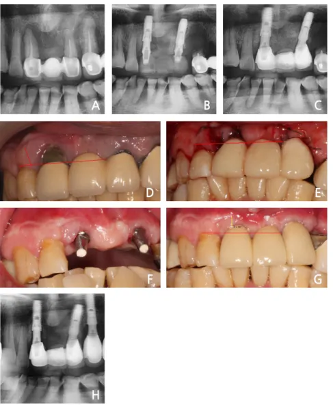 Fig. 7. (A) Bone resorption on the maxilla anterior area, (B) Immediate implant placement with bone  graft, (C) Final loading after 2 weeks, (D) Preoperative gingiva recession on the right maxillary incisor,  (E) Postoperative immediate provisional crown (