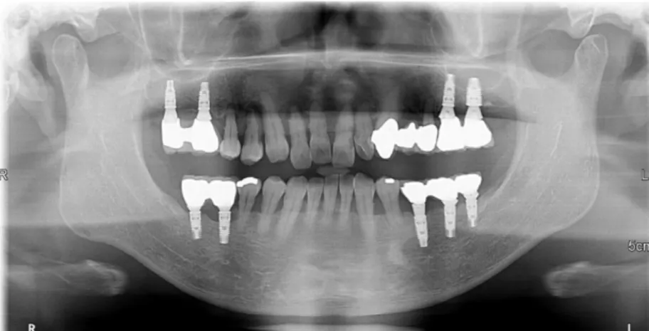 Fig. 2. Case 1: Panoramic radiograph at 4 months after extraction of the maxillary anterior teeth.
