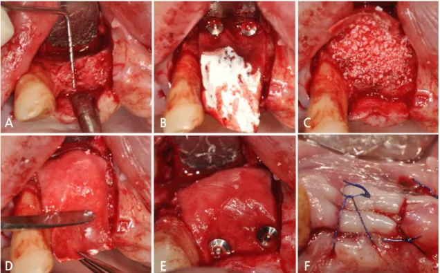 Fig. 4. Case 1: Clinical photographs of implant placement. (A) Horizontally augmented alveolar bone  was observed after buccal flap elevation, (B) Implant placement was performed without additional  guided bone regeneration, (C) The flap was secured using 