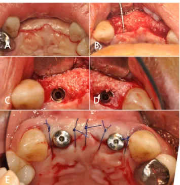 Fig. 9. Clinical photographs of implant placement. (A) Crestal incision for implant placement, (B)  Horizontally augmented ridge observed after buccal flap elevation, (C), (D) Implant placement without  additional guided bone regeneration, (E) Simple inter