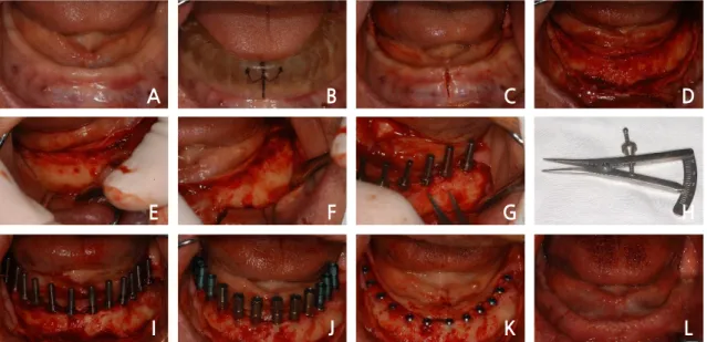 Fig. 1. Case I: Pre-operative panoramic radiograph.