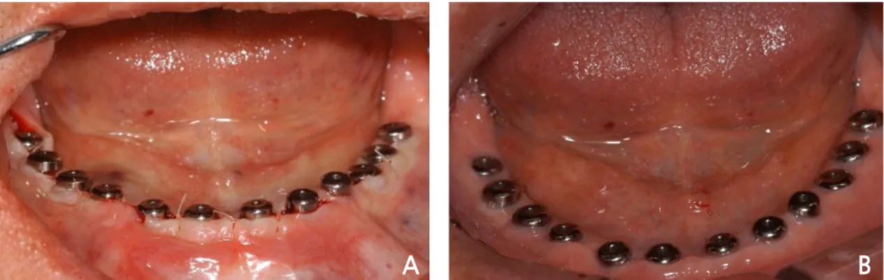 Fig. 4. Case I: Intraoral view of the final restoration.