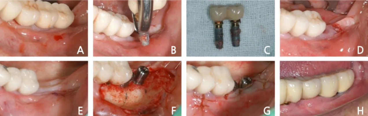 Fig. 7. Case I: Removal of the failed implants and implant replacement surgery. (A) Implants showing  peri-implantitis, (B) implant removal, (C) removed implants, (D) intra-oral site after implant removal, (E)  pre-operative site, (F) implant replacement s
