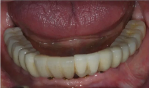 Fig. 9. Case I: Intraoral view of the final restoration after 15 years.