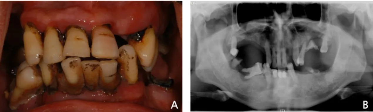 Fig. 11. Case II: Intraoral view (A) and panoramic view (B) at the first visit.