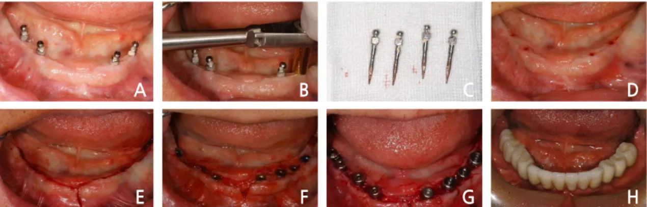 Fig. 14. Case II: Intraoral views of the second-stage implant surgery and the final restoration