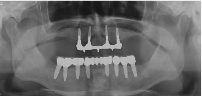 Fig. 16. Case II: Panoramic radiograph of the final restoration after 8 years.