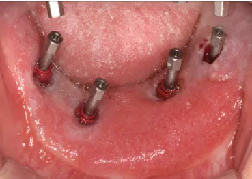 Fig. 4. Impression coping connection for the final impression. Most of the impression copings are  buried in the surrounding soft tissue.