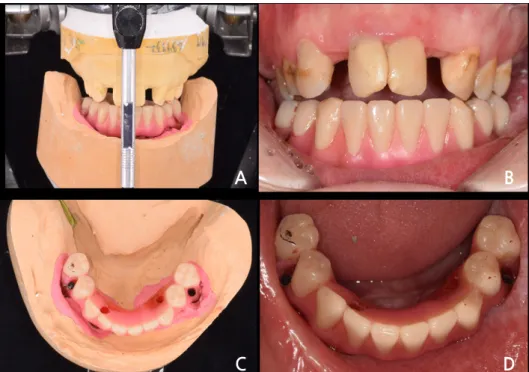 Fig. 5. Diagnostic artificial teeth arrangement. (A), (B) Anterior view, (C), (D) occlusal view.